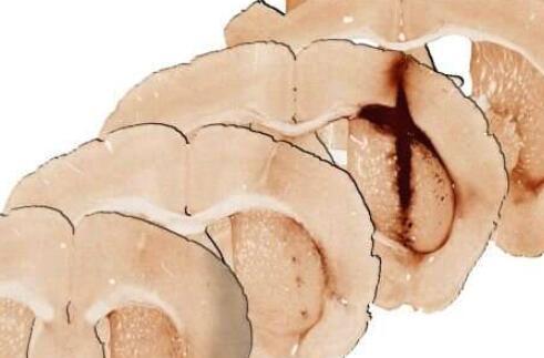 新型水凝胶干细胞治疗修复小鼠受损脑组织