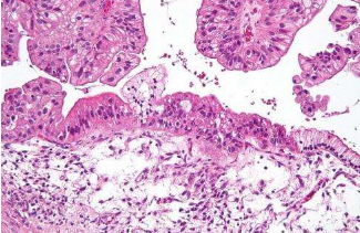 临床前研究确定了复发性卵巢癌的新靶点