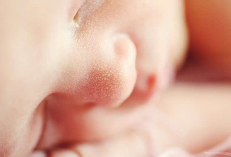 与婴儿湿疹 喘息和鼻病有关的基因缺陷