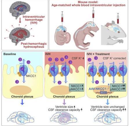 研究表明基因治疗可以缓解出血后脑积水