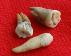 研究发现牙齿可以保存数百年前的抗体